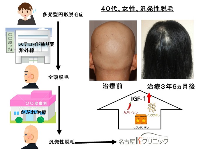 円形脱毛症　病院